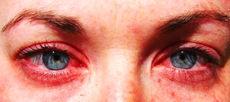 Röda ögon